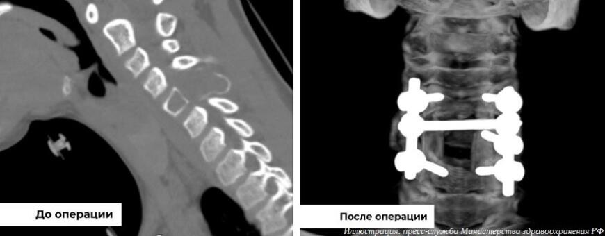 Хирурги НМИЦ травматологии и ортопедии имени Приорова прооперировали ребенка с  применением технологий 3D-печати
