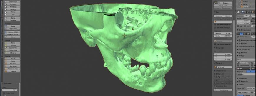 3D печать в челюстно-лицевой хирургии