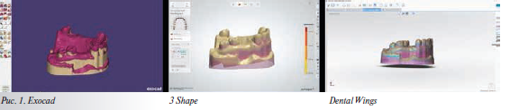 Изготовление бюгельного протеза с помощью 3D печати