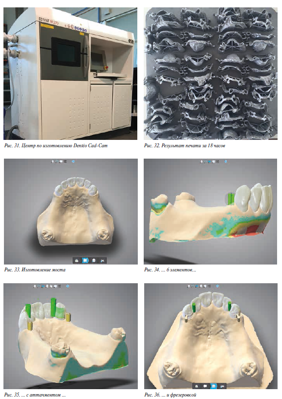 Изготовление бюгельного протеза с помощью 3D печати