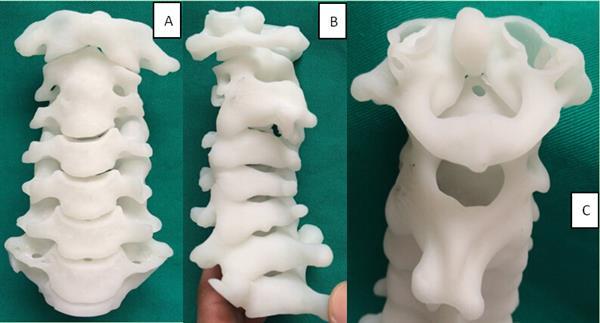 3D-печатная копия позвоночника пациентки помогла врачам провести сложную операцию