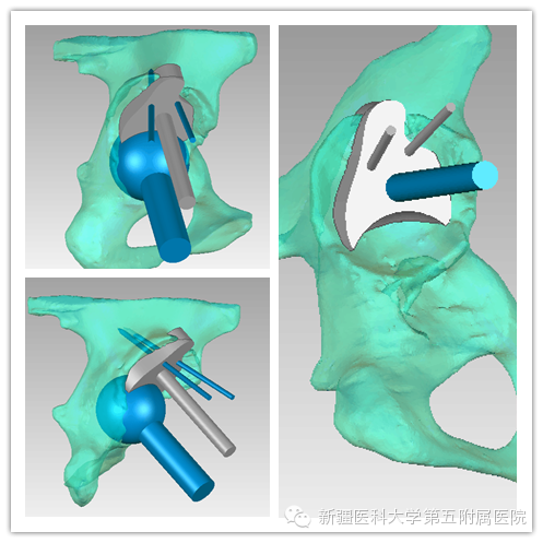 3D-печать помогла китайским врачам провести сложную операцию