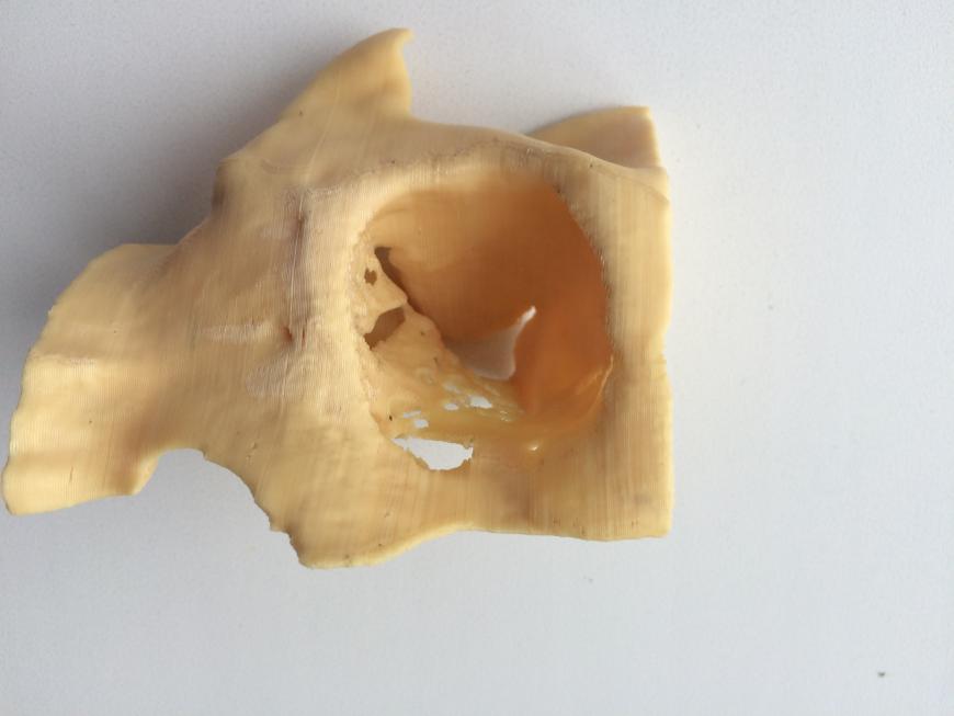 Роль 3D моделирования в операции по восстановлению дна глазницы после перелома