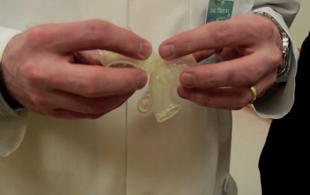 3D-печатная модель сердца помогла хирургам успешно провести сложную операцию