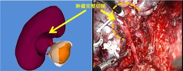 3D-печать помогла китайским врачам удалить опухоль почки