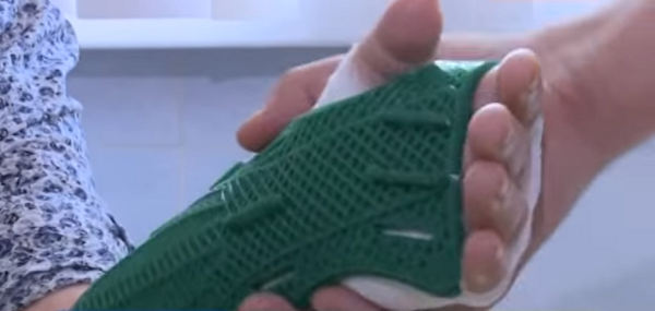 В Иванове пациентам с переломами предлагают 3D-печатные ортезы