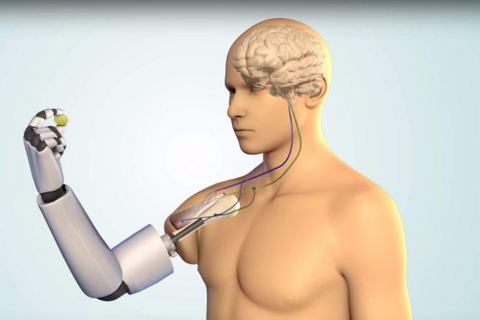 Австралийские ученые работают над бионическим протезом, способным ощущать прикосновения
