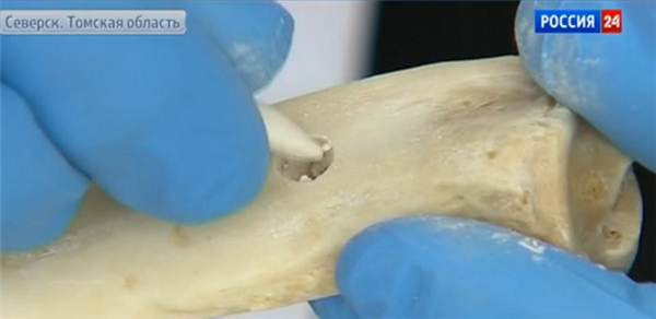 Российские ученые изобрели «костный цемент» для быстрого заживления переломов