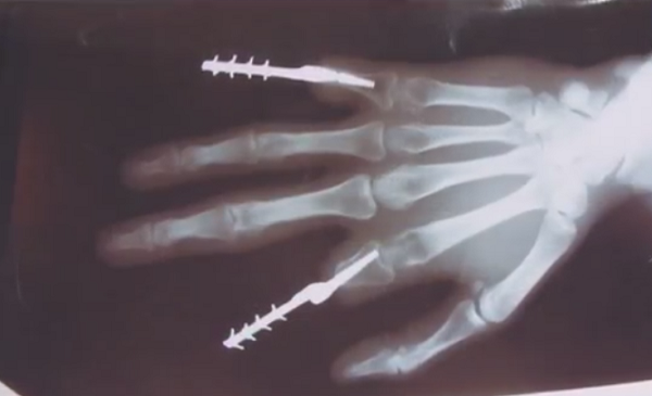 Курганские ученые провели успешные испытания вживляемых 3D-печатных протезов пальцев