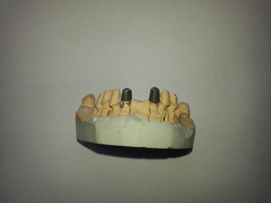 Пробная печать зубных протезов из металла по технологии SLM.