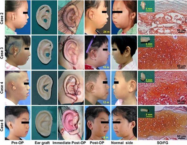 Индийские врачи продвигают программу имплантации 3D-печатных ушных раковин