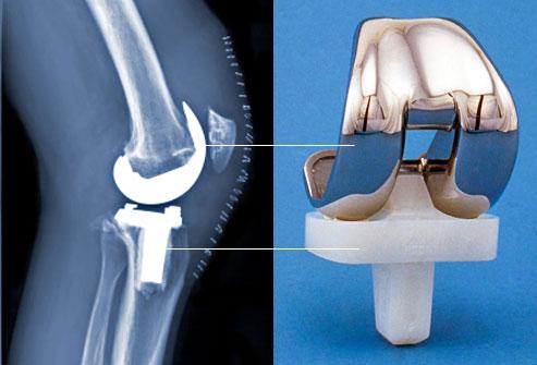 Инженер из Университета Уотерлу разработала 3D-принтер для изготовления костных и хрящевых имплантатов