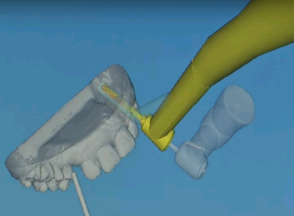 Китайский робот-стоматолог провел свою первую операцию по вживлению 3D-печатных зубов