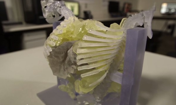 3D-печать помогла разделить 10-месячных сиамских близнецов