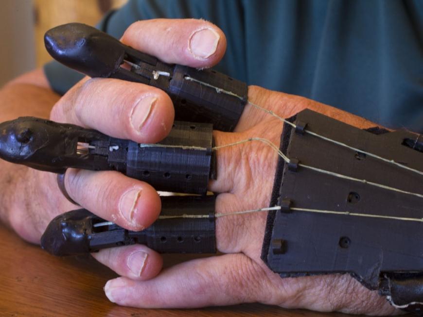 3D-печатные пальцы подарили надежду жертве несчастного случая