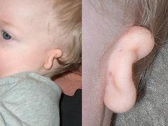 3D-печать поможет исправлять врожденные деформации наружного уха