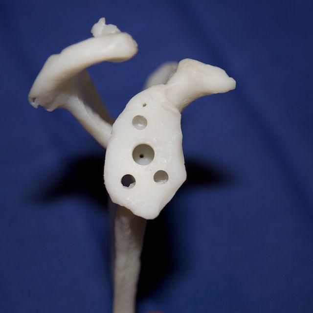 Хирурги провели успешную операцию на плече пациентки благодаря 3D-печати