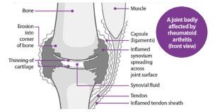 Разрушающее действие ревматоидного артрита на суставы (вид спереди) 
