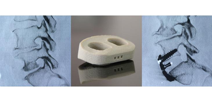 Французский хирург провел операцию по сращиванию позвонков с применением 3D-печатных межпозвонковых кейджей