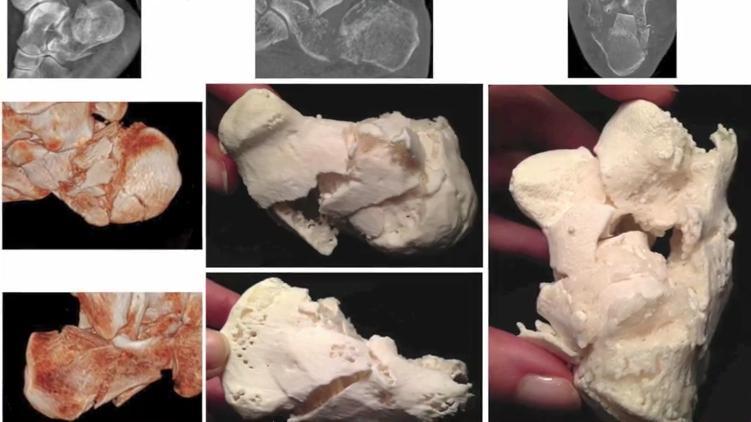Итальянские хирурги печатают на 3D-принтере копии переломов для успешного проведения операции