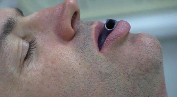 3D-печатная капа во рту спящего пациента
