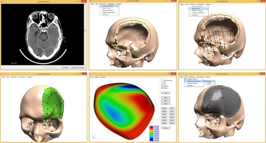 Новосибирский разработчик программы для 3D-моделирования имплантатов стал лауреатом выставки «Архимед-2020»