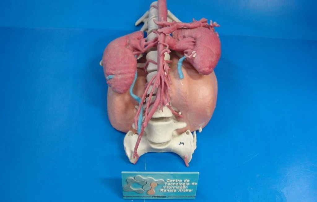 3D-печатная модель, которая помогла хирургам удалить опухоль и несколько позвонков у 12-летней девочки