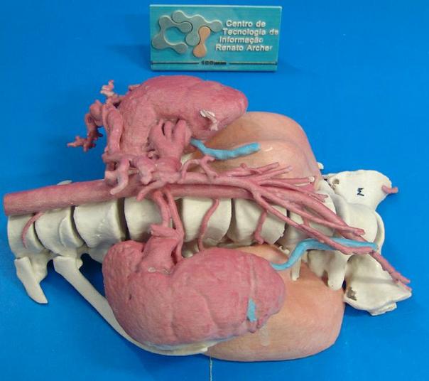 3D-печатная модель опухоли, почек, артерий и т.д.