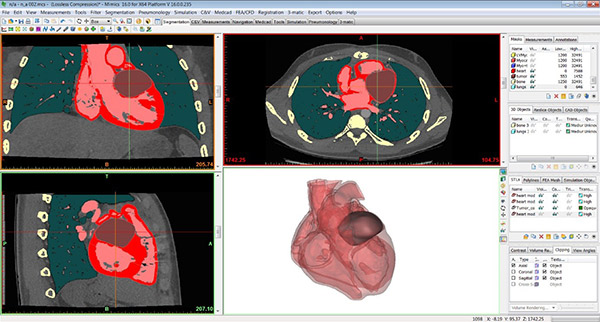Bradleys-CT-image-showing-tumor.jpg