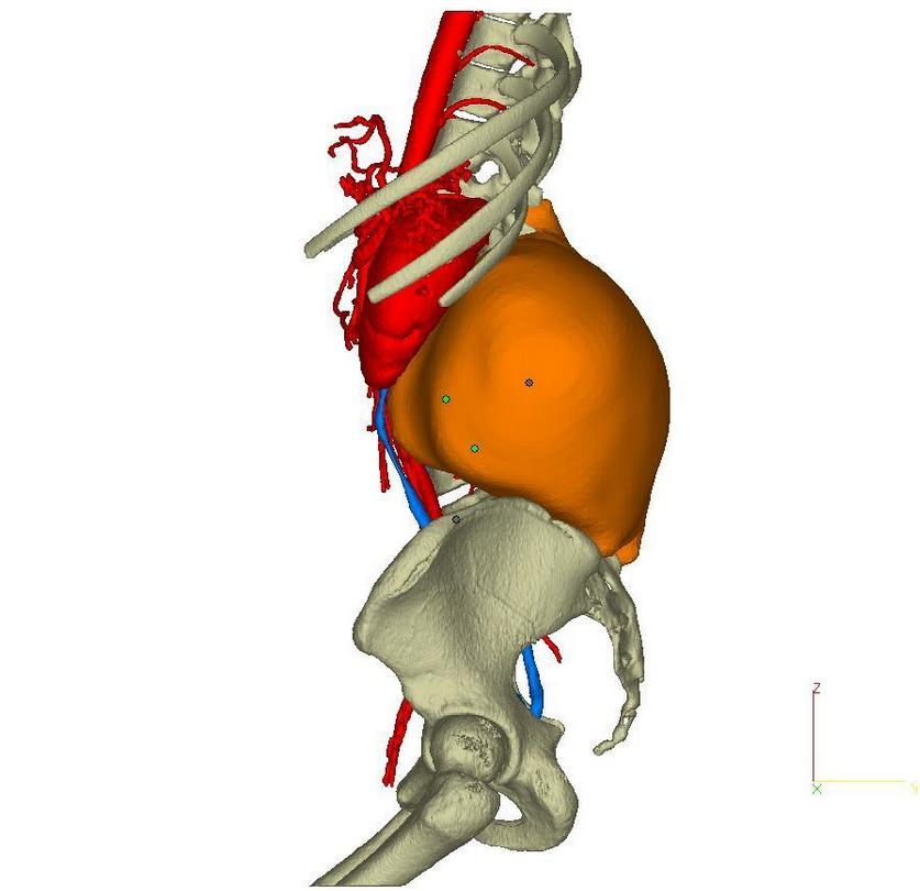 Виртуальная 3D-модель опухоли
