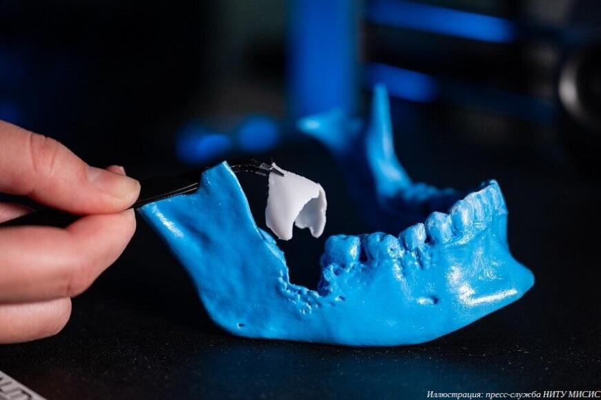 Исследователи из НИТУ МИСИС разработали стоматологическую мембрану с антибактериальным покрытием
