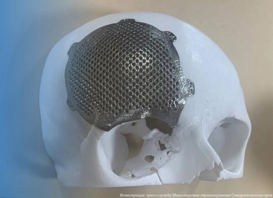 Ставропольские врачи вернули девушке зрение с помощью 3D-печати