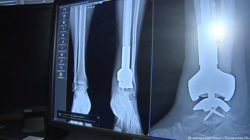 Врачи татарстанского республиканского онкологического диспансера установили 3D-печатный эндопротез