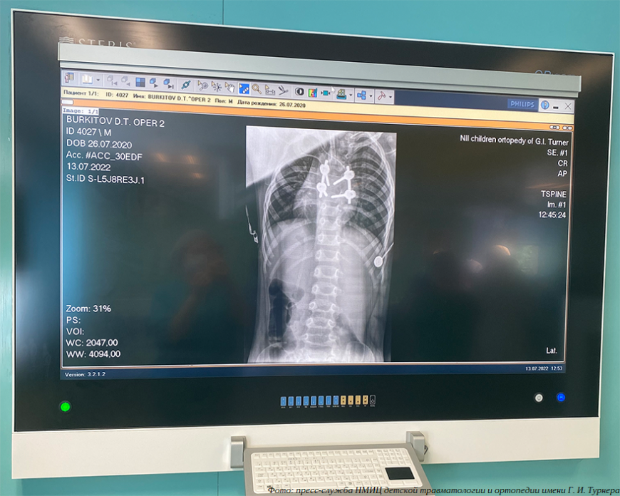 Петербургские врачи прооперировали двухлетнего ребенка с применением технологий 3D-печати