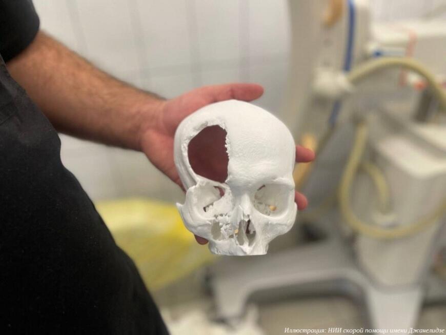 Петербургские врачи провели операцию по восстановлению глазницы с помощью 3D-технологий