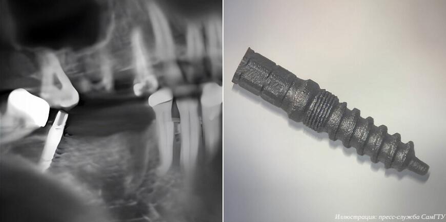 Самарские врачи впервые в России установили дентальный имплантат с индивидуальной конструкцией резьбовой части