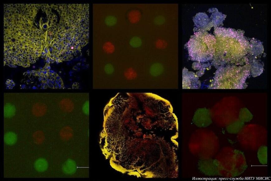 В НИТУ МИСИС напечатали модель раковой опухоли на 3D-биопринтере