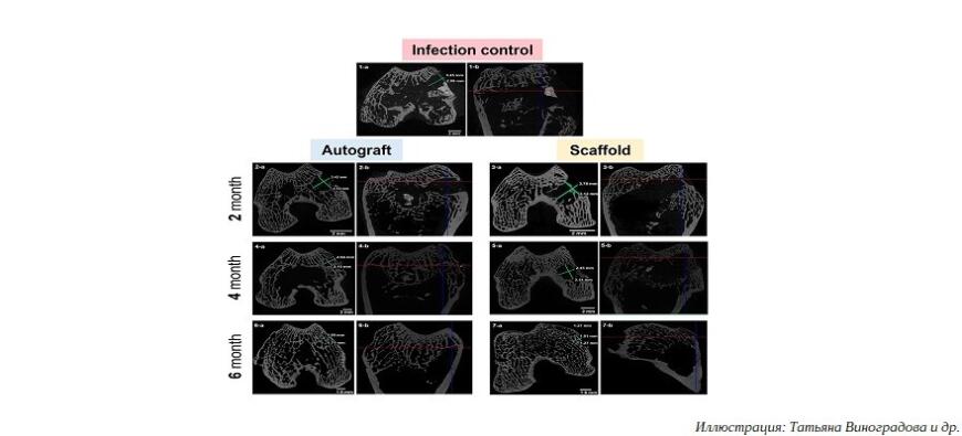 Курчатовский институт разработал материал для 3D-печати биодеградируемых костных имплантатов