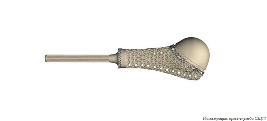 На российском рынке появился 3D-печатный имплантат плечевого сустава с модифицированной поверхностью