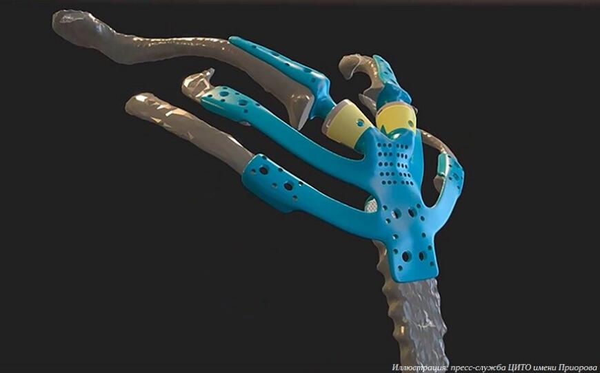 3D-печатные грудные протезы разработки ЦИТО установлены первым трем пациентам