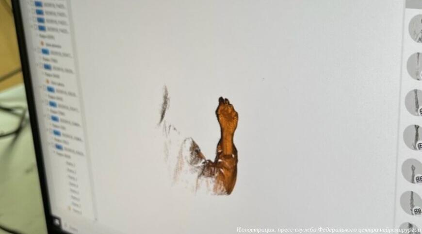 В Тюмени открывается лаборатория нейрохирургического прототипирования