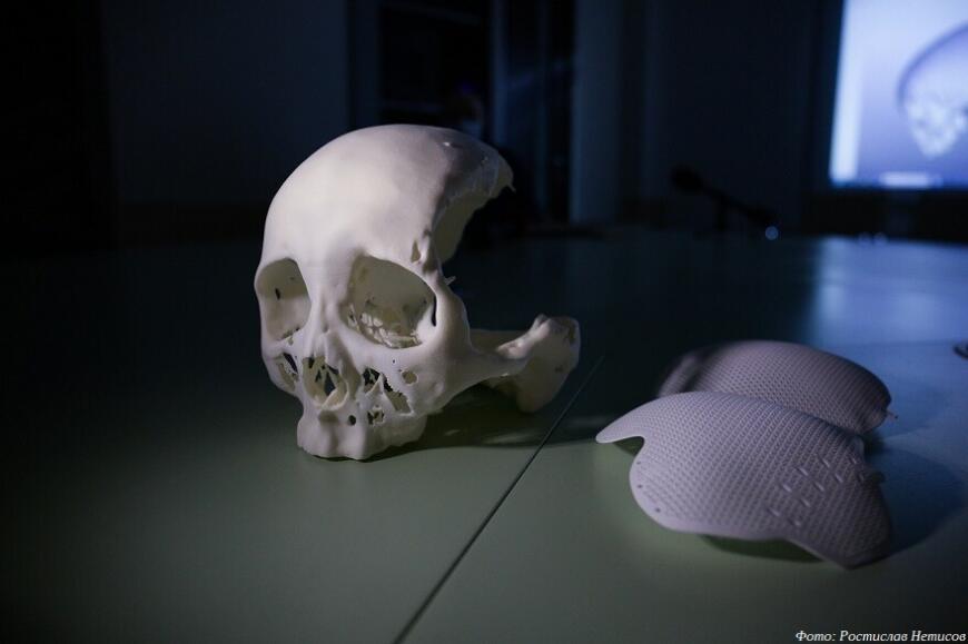 Новосибирские хирурги провели уникальную операцию по реконструкции черепа