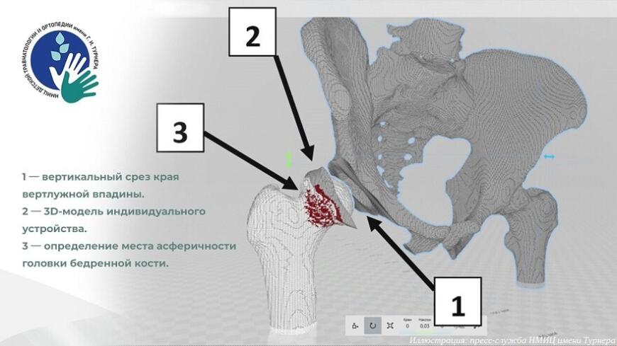 В НМИЦ имени Турнера используют 3D-печатные хирургические шаблоны В НМИЦ имени Турнера используют 3D-печатные хирургические шаблоны