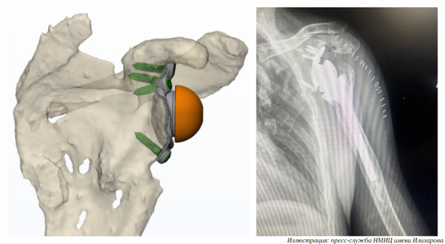 Врачи Центра Илизарова вернули пациенту подвижность руки с помощью 3D-печатного эндопротеза