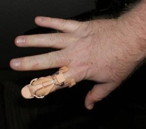 3D-печатный протез указательного пальца вид сверху