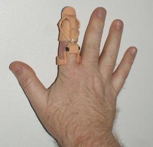 3D-печатный протез кончика указательного пальца