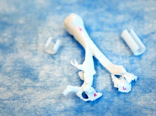 3D-печатная шина для трахеи помогла выжить еще одному ребенку с диагнозом трахеобронхомаляция