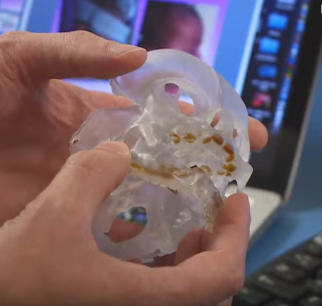 3D-печатные вставки для щек хирурги применили для операции у новорожденного.
