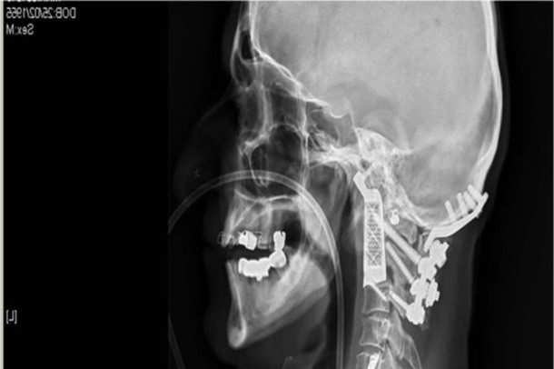 Пациенту впервые имплантировали '3D-позвонки'