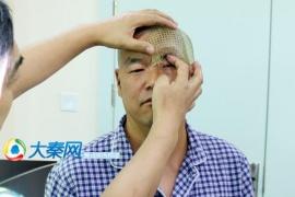 Врачи восстановили форму черепа пациента с помощью 3D-печатной титановой сетки